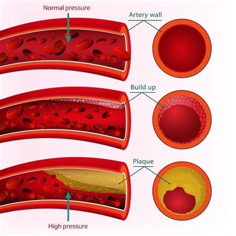 High Blood Pressure And Vascular Disease — Vascular Cures