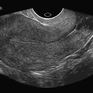 Transvaginal Ultrasound Of The Adnexa Note Cystic Structure With A