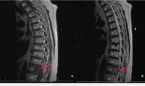 A MRI Of The Lumbar Spine Revealing Lytic Lesions At T11 B Moderate