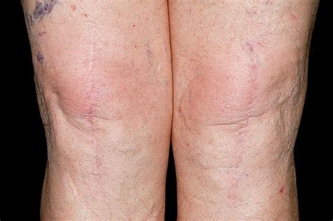 Find the perfect knee replacement scar stock photos and editorial news pictures from getty images. Total Knee Replacement Scars Photograph by Dr P. Marazzi ...
