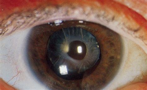 Cataract Physical Examination Wikidoc