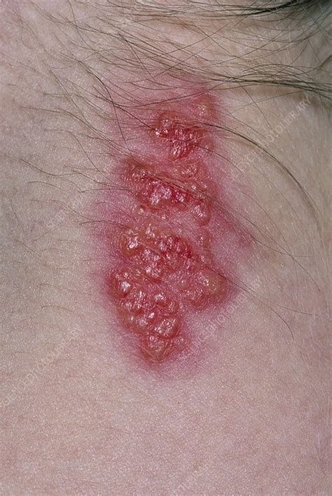 Close Up Of Shingles Rash On Back Of Womans Neck Stock Image M260