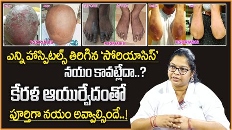 Complete Psoriasis Cure In Ayurveda Sri Bhaskara Kerala Ayurvedic Hospital Sumantv Youtube