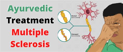 Treatment Of Multiple Sclerosis According To Ayurveda