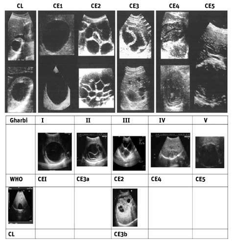 Gharbi Classification Of Hydatid Cyst Imaging In Echinococcosis