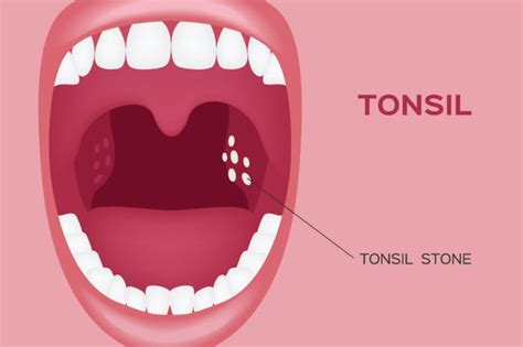 Tonsil Stones Signs Symptoms And Treatment The Healthy