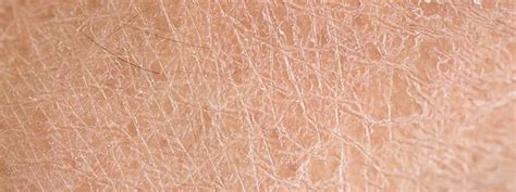Dry Skin Causes Treatment Remedies And How To Get Rid Of It