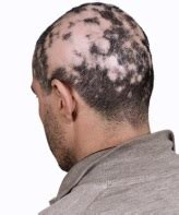 Kreisrunder Haarausfall Ursachen Verlauf Diagnose Behandlung