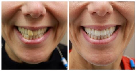 Smile Makeover Nyc Treatment Options And Cost 209 Nyc Dental