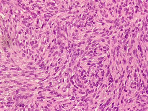 Pathology Outlines Angiomatoid Fibrous Histiocytoma