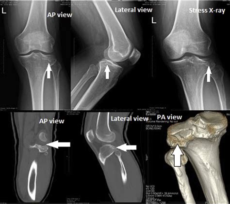 Left Knee Type Iii Lateral Tibial Plateau Fracture On Anteroposterior