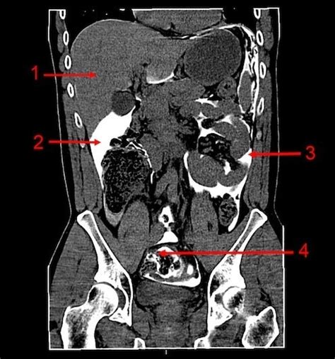 CT Abdomen Coronal With Rectal Contrast 1 Liver 2 Open I