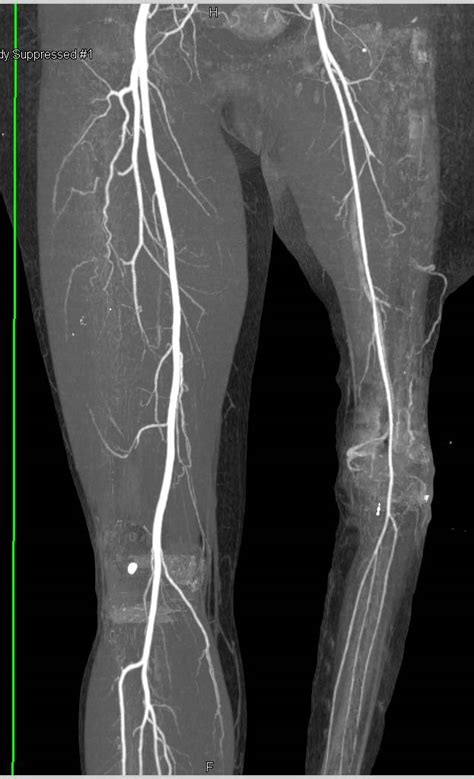 Cta Runoff In Patient With Reimplanted Lower Extremity Vascular Case