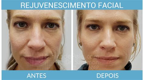 Rejuvenescimento Facial Tratamentos Dermatol Gicos Cl Nica De Pele