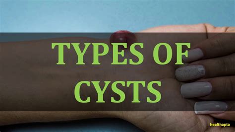 Types Of Cysts Youtube