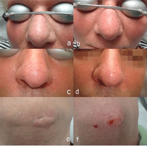 Erbium YAG Laser Treatment Of Facial Lesions Sebaceous Gland Download Scientific Diagram