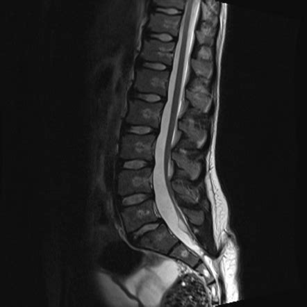 Tethered Cord Syndrome Radiology Reference Article Radiopaedia Org