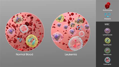 Leukemia Leukaemia Types Causes Symptoms And Treatments