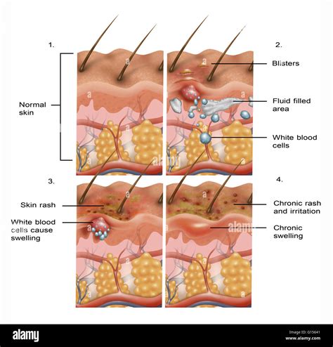 Cross Section Illustration Of The Formation Of Eczema On The Skin In