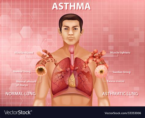 Human Anatomy Asthma Diagram Royalty Free Vector Image