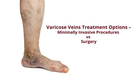 Varicose Veins Treatment Invasive Procedures Vs Surgery Drabhilash Dr Abhilash