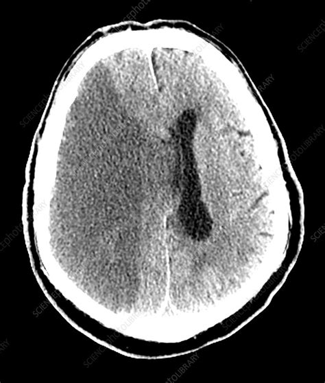 Large Stroke Ct Scan Stock Image C0271876 Science Photo Library