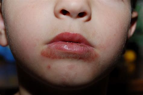 How To Treat Rash Around Toddlers Mouth