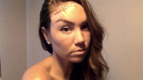Tanning Addict Left With Hole In Head From Cancer After Using Sunbeds
