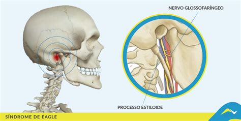 Síndrome De Eagle Fascio Radiologia