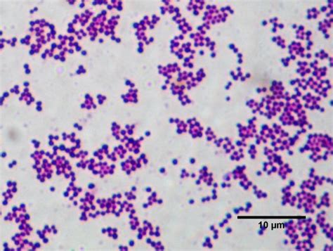 Tangents Sab Staphylococcus Aureus Bacteremia