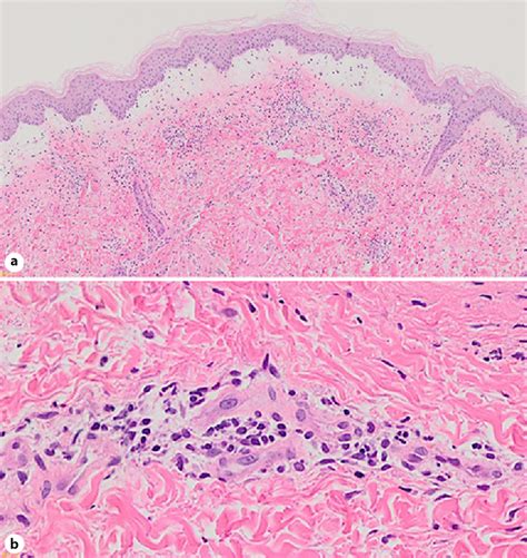 Managing Cutaneous Vasculitis In A Patient With Lupus Erythematosus
