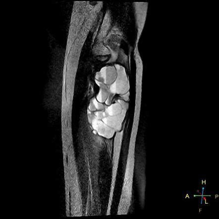 Aneurysmal Bone Cyst Radiology Reference Article Radiopaedia Org