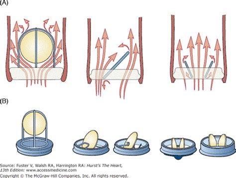 Prosthetic Heart Valves Thoracic Key