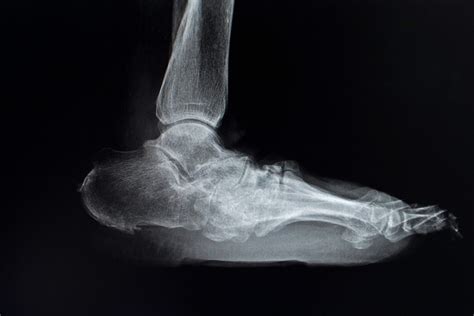 Charcot Arthropathy Custom Orthotic