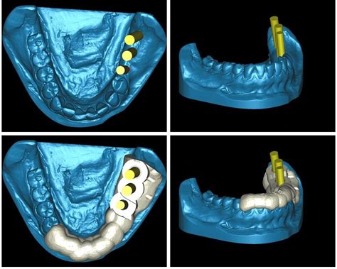 Implantes Dentales Con Cirug A Guiada La T Cnica M S Avanzada Y