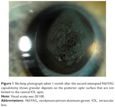 Treatment Of Dystrophic Calcification On A Silicone Intraocular Lens W