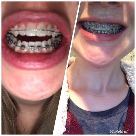 First Day Of Braces Vs 8 Months Of Bracesdouble Jaw Surgery Rbraces