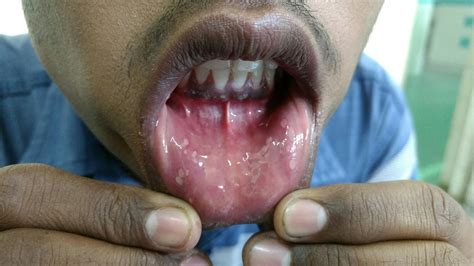 Multiple Small Painful Ulcers In Oral Cavity With Slightly Coated