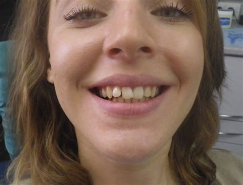 Richard Charon Bds Snaggle Teeth To Lovely Smile With Invisalign