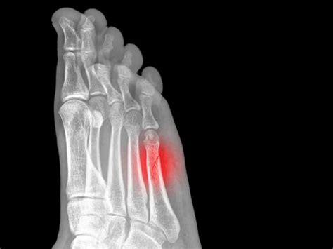 Metatarsal Fracture Causes Symptoms And Treatment Of Metatarsal Fractures
