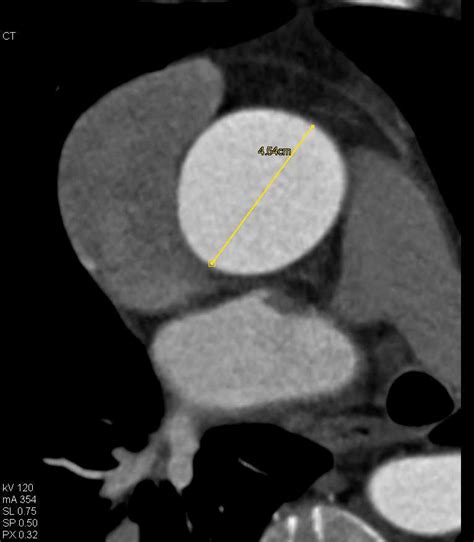Aortic Stenosis With Extensive Aortic Valve Calcification Cardiac