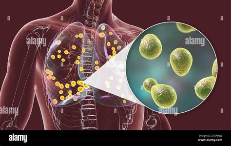 Lung Histoplasmosis A Fungal Infection Caused By Histoplasma