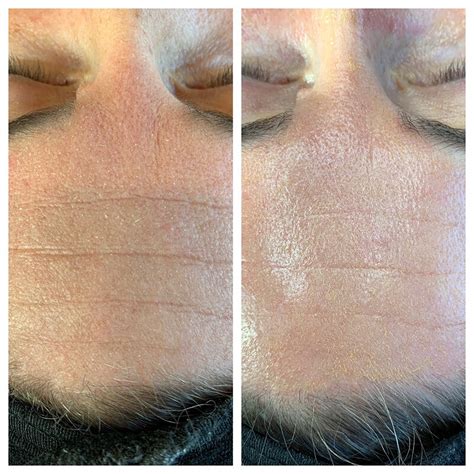 Best Hydrafacial In Denver Hydrafacial Before And After Mooi