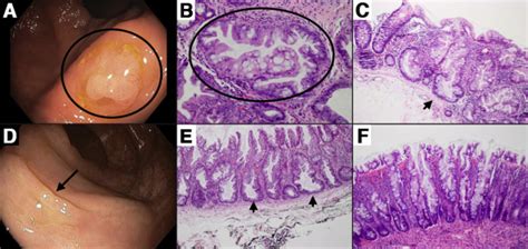 Detection Diagnosis And Resection Of Sessile Serrated Adenomas And