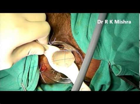 Stapled Hemorrhoidectomy From Youtube The Fastest Of Mp Search Engine