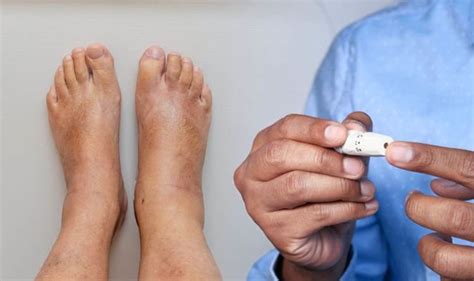 Diabetes Signs In Your Feet The 14 Symptoms To Watch Out For Uk