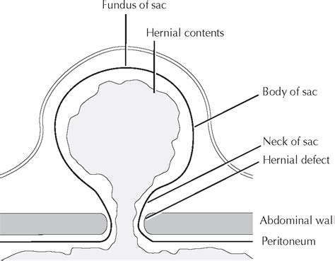 Umbilical Hernia Anatomy