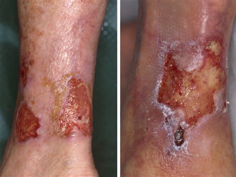 Martorell's ulcer or necrotic angiodermatitis is a painful ulceration of the lower leg associated with diastolic arterial hypertension. Ulcus hypertensivum van Martorell