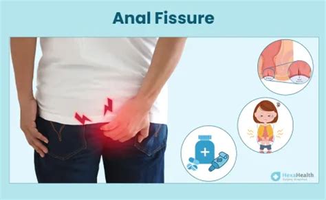 Anal Fissure Images Symptoms Causes Cure Treatment
