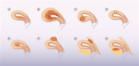 How To Diagnose Adenomyosis Why Are We Missing It Sydney Fibroid Clinic